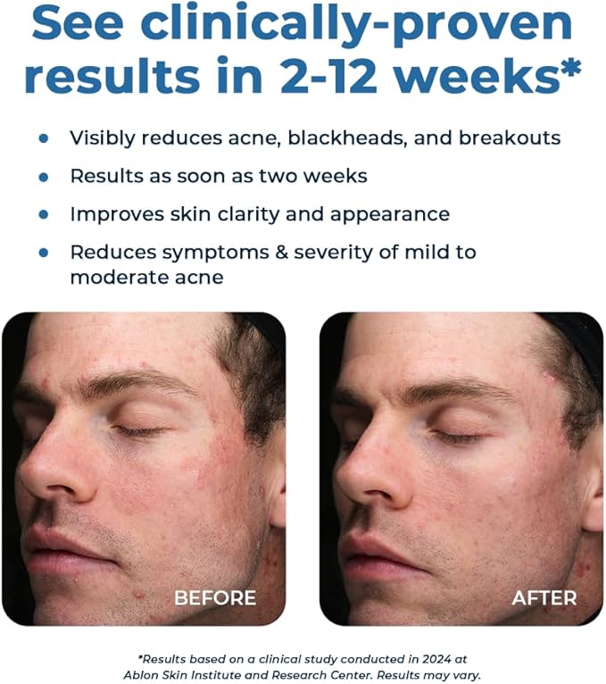 VitaMedica Clear Skin Vitamin Formula | Acne Supplement for Skin Clearing | Breakout Treatment for Women and Men | Vitamins A, C, E, Selenium, Chromium, and Zinc for Acne and Skin Health | 60 Count