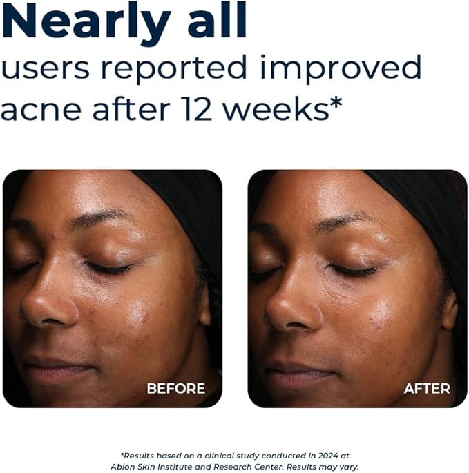 VitaMedica Clear Skin Vitamin Formula | Acne Supplement for Skin Clearing | Breakout Treatment for Women and Men | Vitamins A, C, E, Selenium, Chromium, and Zinc for Acne and Skin Health | 60 Count